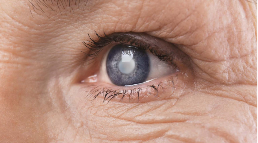 Cataract (Motiyabind): Symptoms, Causes & Modern Treatment Options